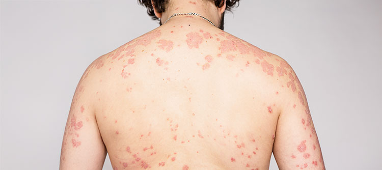 patient receiving autoimmune disease treatment in Irvine with mild hyperbaric oxygen therapy