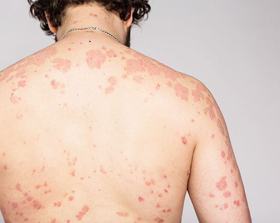 patient receiving hyperbaric oxygen treatments in Irvine for autoimmune disease